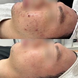 [뷰티] [인천 미추홀구] 12만원 상당의 트러블 압출 관리