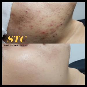 [뷰티] [경기 김포시] 20만원 상당의 맞춤피부 케어